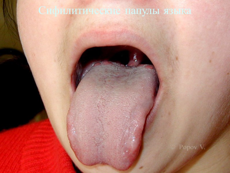 Сифилитические папулы языка